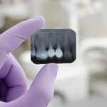 Dental Fillings